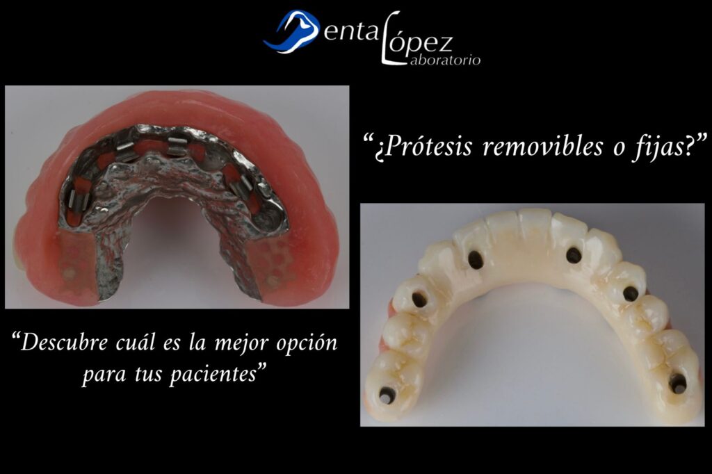 ¿Prótesis removibles o fijas?