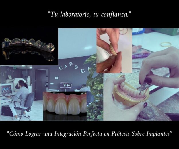 Cómo Lograr una Integración Perfecta en Prótesis Sobre Implantes